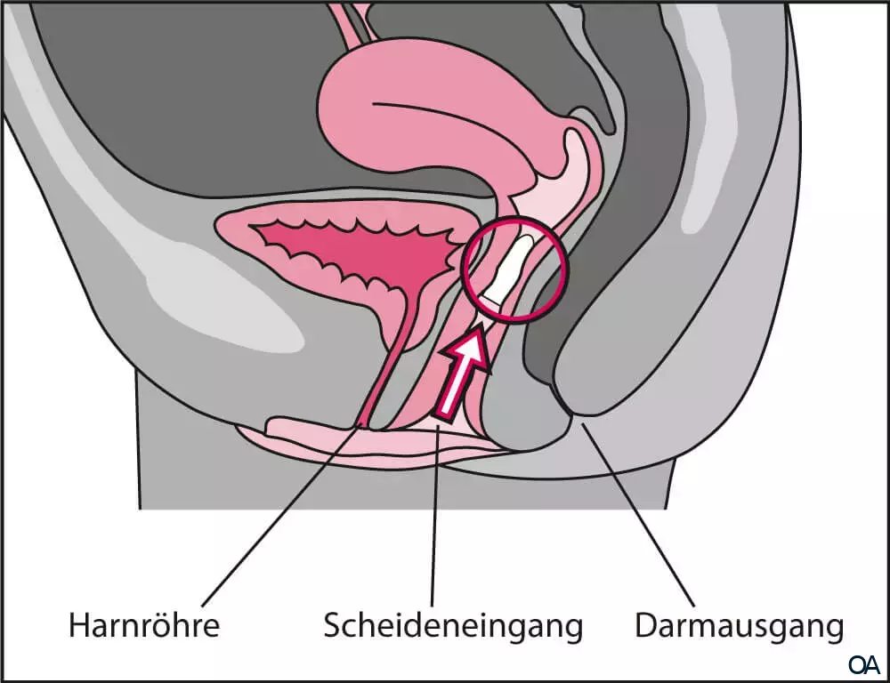 Vagisan FeuchtCreme Cremolum Zäpfchen